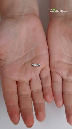 Monkeypox preventions Tips