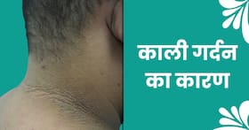 सिर्फ मैल के कारण नहीं होती गर्दन काली, ये 7 बीमारियां हैं गर्दन के कालेपन की वजह, जानिए उपचार