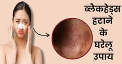 चेहरे पर ब्लैकहेड्स क्यों होते हैं? जानें छुटकारा पाने के आसान घरेलू उपाय