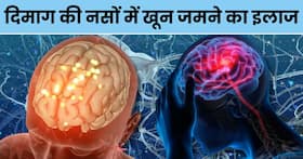दिमाग की नसों में खून जमने पर अपनाएं ये 5 चमत्कारी उपाय, मिनटों में खुल जाएंगी बंद नसें