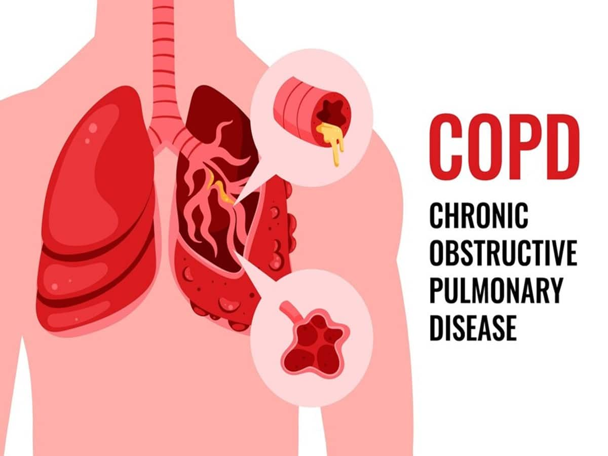 Chronic Obstructive Pulmonary Disease (COPD)