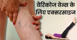 वैरीकोज वेन्स की समस्या को दूर करने में फायदेमंद हैं ये 4 एक्‍सरसाइज, रोजाना सिर्फ 10 मिनट करने से मिलेगा लाभ