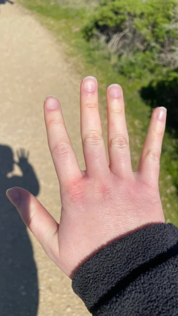 डायबिटीज में हाथों और उंगलियों के आसपास दिखते हैं ये 7 लक्षण