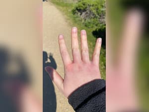 डायबिटीज में हाथों और उंगलियों के आसपास दिखते हैं ये 7 लक्षण