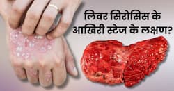 लिवर सिरोसिस के आखिरी स्टेज में शरीर देता है ये 6 संकेत, तुरंत पहचानकर कराएं इलाज