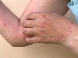 कैसे पहचानें मंकीपॉक्स से संक्रमित हैं या नहीं? जानें इसके लक्षण, इलाज और दवा के बारे में सब कुछ