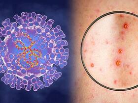 Mpox Outbreak In India: AIIMS Delhi Issues Protocol For Treating Suspected Monkeypox Patients Mpox Outbreak In India: AIIMS Delhi Issues Protocol For Treating Suspected Monkeypox Patients