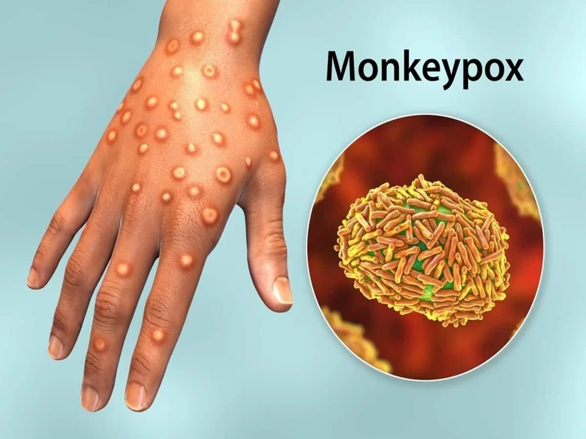 Mpox Alert In Kerala Over Global Outbreak Tamil Nadu Issues Screening   Mpox Virus Outbreak 