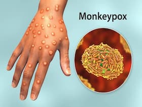 Mpox Alert In Kerala Over Global Outbreak, Tamil Nadu Issues Screening Protocol Mpox Alert In Kerala Over Global Outbreak, Tamil Nadu Issues Screening Protocol