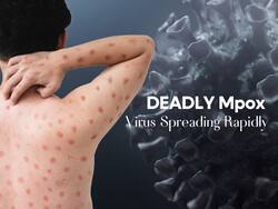 Deadliest Mpox Virus Spreading Rapidly In African Countries: WHO Calls For Emergency Meet