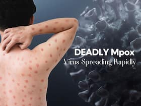 Deadliest Mpox Virus Spreading Rapidly In African Countries: WHO Calls For Emergency Meet Deadliest Mpox Virus Spreading Rapidly In African Countries: WHO Calls For Emergency Meet