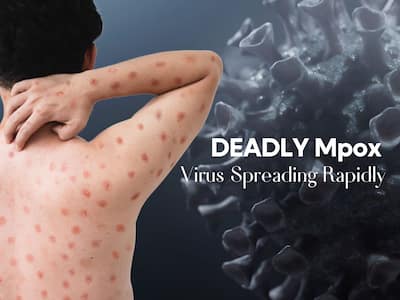 Deadliest Mpox Virus Spreading Rapidly In African Countries: WHO Calls For Emergency Meet
