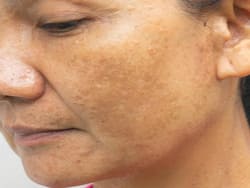 जिद्दी झाइयों को हटाने के लिए लगाना शुरू कर दें किचन में रखी ये 5 चीजें, महंगी क्रीम्स की नहीं पड़ेगी जरूरत