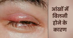 इन 5 कारणों से हो सकती हैं आंखों में बिलनी (गुहेरी) की समस्या, इन लक्षणों से तुरंत करें पहचान