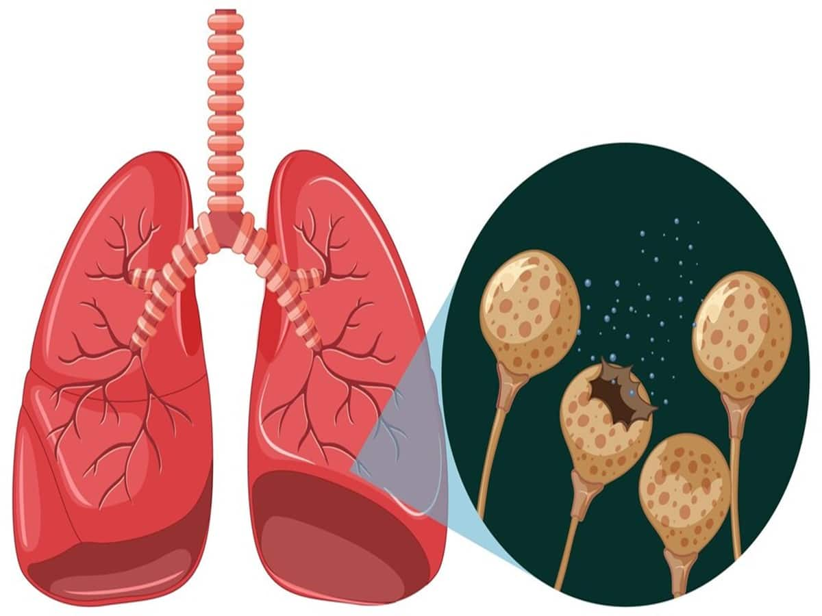 Tuberculosis (TB)