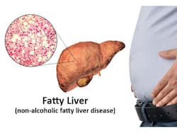 Fatty Liver Causes: 5 Nighttime Habits That Can Increase Fat Buildup in the Liver While Sleeping