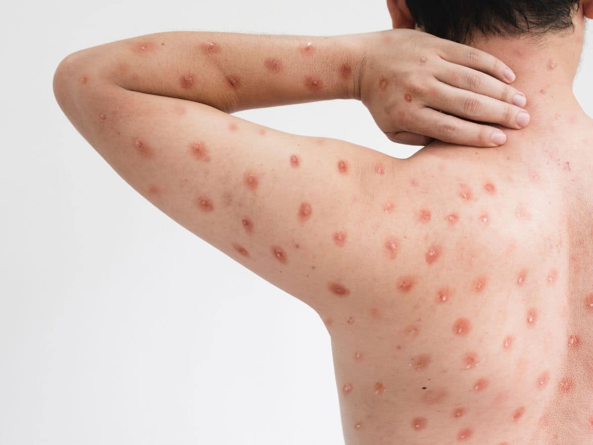 Baccho Mpox ke Lakshan | बच्चों में अधिक है मंकीपॉक्स होने का खतरा, इन