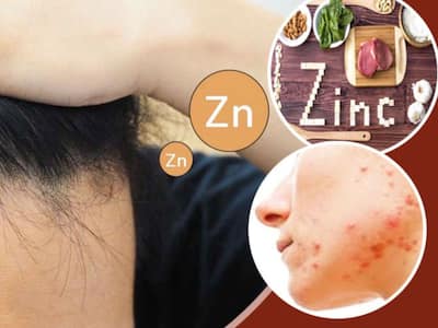 Zinc Deficiency Rash Zinc Deficiency Signs & Symptoms (ex. Hair Loss,