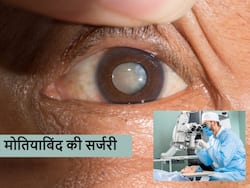 मोतियाबिंद की सर्जरी से पहले इन बातों का ध्यान नहीं रखा तो आंख हो सकती है डैमेज, डॉक्टर ने किया सावधान