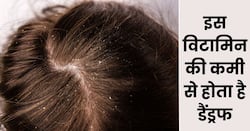 मौसम नहीं बल्कि इन 2 विटामिंस की कमी से होता है सिर में डैंड्रफ, ऐसे पाएं सही खुराक