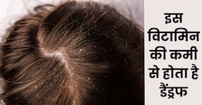 मौसम नहीं बल्कि इन 2 विटामिंस की कमी से होता है सिर में डैंड्रफ, ऐसे पाएं सही खुराक
