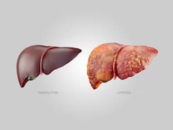 Liver Cirrhosis Ke Lakshan