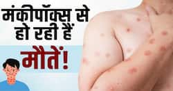 Monkeypox cases: मंकीपॉक्स के इन लक्षणों को ना करें इग्नोर!
