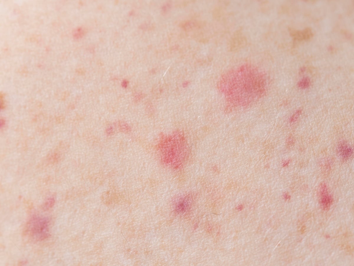 Signs of Poor Health: 7 Warning Signs That Appear On Your Skin Before Turning 30