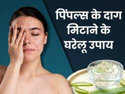 चेहरे की खूबसूरती खराब कर सकते हैं मुंहासों के दाग-धब्बे, इन 5 घरेलू नुस्खों से पाएं बेदाग स्किन