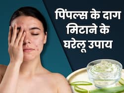 चेहरे की खूबसूरती खराब कर सकते हैं मुंहासों के दाग-धब्बे, इन 5 घरेलू नुस्खों से पाएं बेदाग स्किन