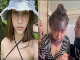 Severe Vaccine Reaction Makes US Woman Unrecognizable; Reports Say She Is Fighting For Her Life