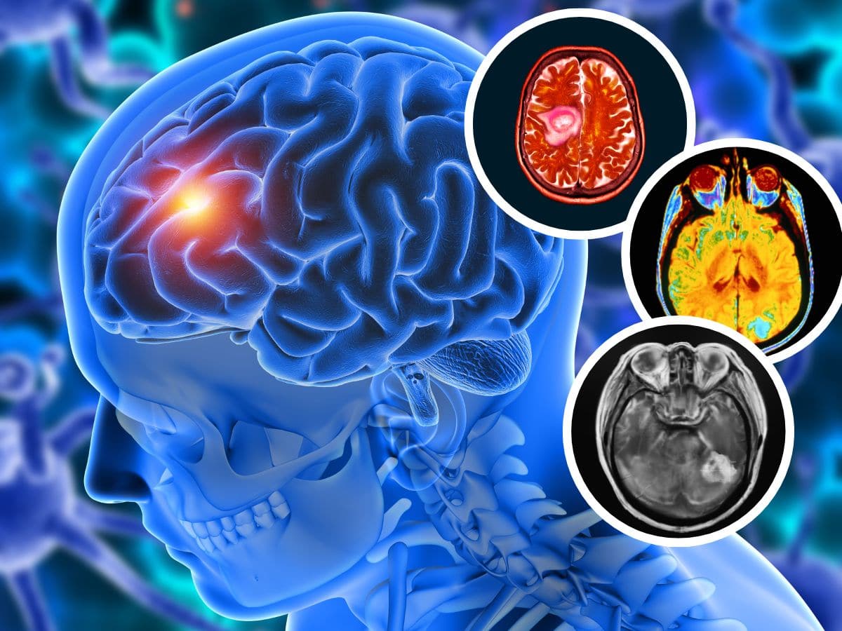 Can Smartphones Cause Brain Cancer? Explains Radiation Oncologist
