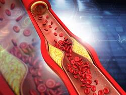 Clogged Arteries Symptoms: 7 Warning Signs of Blockages in Coronary Arteries That Shouldn't Be Ignored