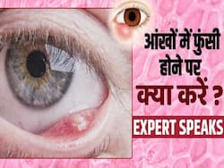 Eye Infection Prevention: बरसात के मौसम में आंखों में होती है ये दर्दनाक समस्या! जानें इसका इलाज