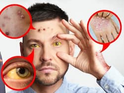 Fatty Liver Symptoms: 5 Facial Signs of Excessive Fat Accumulation In Liver