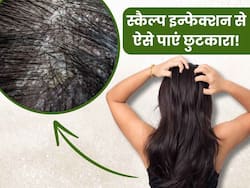 स्कैल्प इंफेक्शन की वजह से बालों में होने लगती है खुजली, इन नुस्खों से पाएं आराम