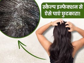स्कैल्प इंफेक्शन की वजह से बालों में होने लगती है खुजली, इन नुस्खों से पाएं आराम स्कैल्प इंफेक्शन की वजह से बालों में होने लगती है खुजली, इन नुस्खों से पाएं आराम