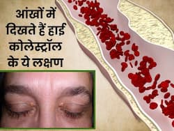 कोलेस्ट्रॉल बढ़ने पर आंखों के आसपास नजर आते हैं ये 4 लक्षण, 90 फीसदी लोग साधारण समझकर करते हैं इग्नोर