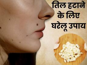 1 हफ्ते में तिल हटाने के लिए अपनाएं ये 5 घरेलू नुस्खे, बिना सर्जरी के हट जाएंगे सारे निशान