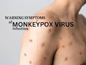 Monkeypox Virus Symptoms: 5 Rare Signs of Mpox Infection Monkeypox Virus Symptoms: 5 Rare Signs of Mpox Infection