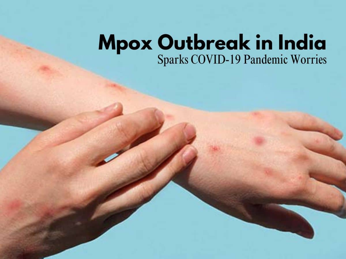 Mpox Alert: India Confirms First Monkeypox Case, Echoes COVID-19 ...