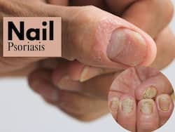 Nail Psoriasis: Dermatologist Shares 5 Unusual Signs of Nail Psoriasis And Ways To Treat Them