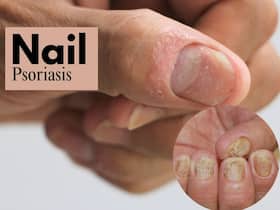 Nail Psoriasis: Dermatologist Shares 5 Unusual Signs of Nail Psoriasis And Ways To Treat Them