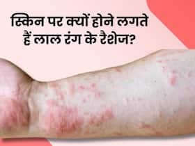 इन 5 बीमारियों की वजह से स्किन पर होने लगते हैं लाल चकत्ते, 99.9 फीसदी लोग करते हैं इग्नोर