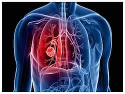 फेफड़ों की बीमारी से बचना है तो इन 6 चीजों को आज ही कहें अलविदा!