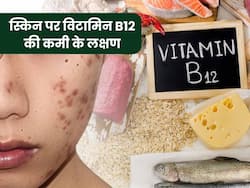 विटामिन बी12 कम होने पर स्किन के आसपास दिखाई देते हैं ये 5 संकेत, इग्नोर करने की न करें गलती
