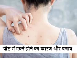 आखिर किस कारण से होने लगते हैं पीठ पर एक्ने स्किन एक्सपर्ट्स ने बताया कारण और बचाव के तरीके