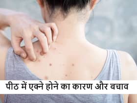 आखिर किस कारण से होने लगते हैं पीठ पर एक्ने स्किन एक्सपर्ट्स ने बताया कारण और बचाव के तरीके