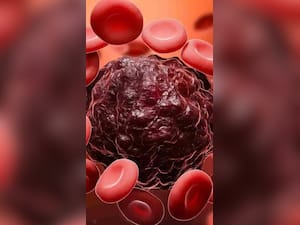 ऐसे दिखते हैं सर्वाइकल कैंसर के शुरुआती लक्षण