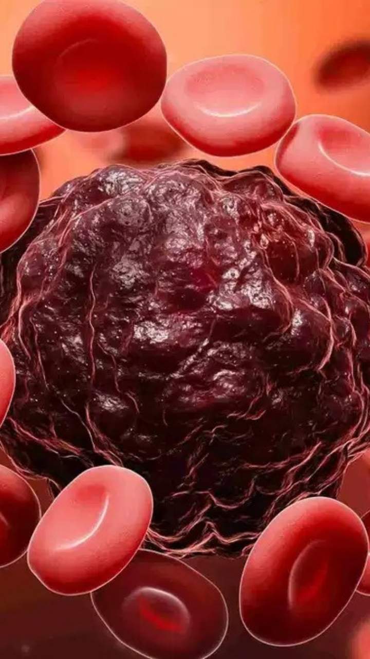 ऐसे दिखते हैं सर्वाइकल कैंसर के शुरुआती लक्षण